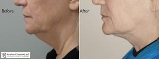 Neck lift liposuction