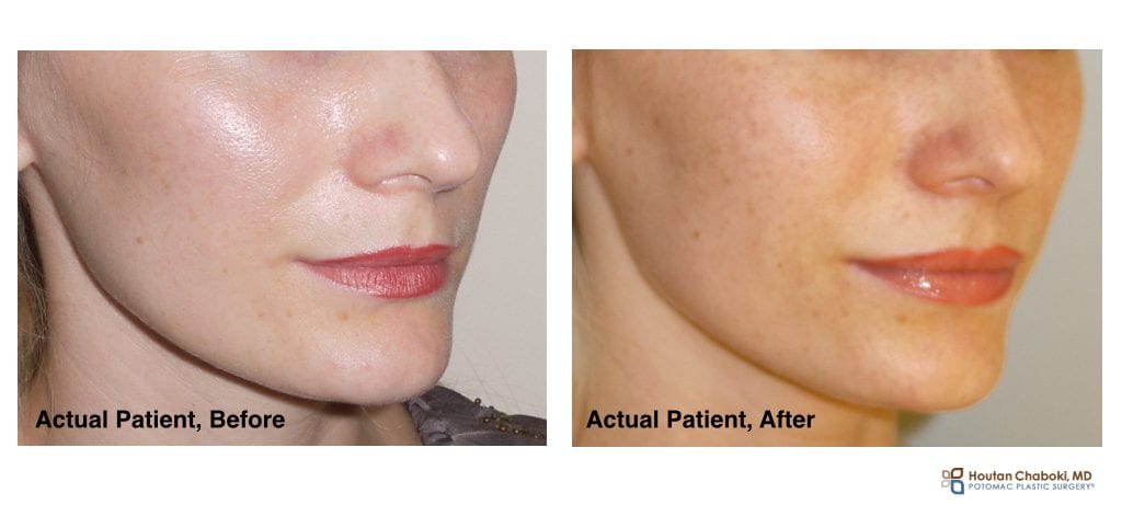 non-surgical, plastic surgery, cheek, filler, cosmetic