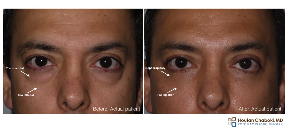 Lower eye bags: Too little or too much fat?