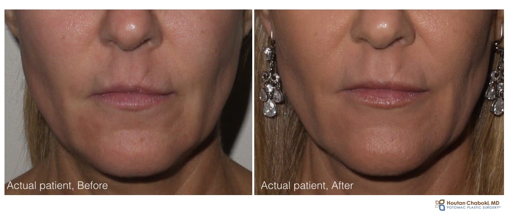 Lip injection with filler - before:after Restylane