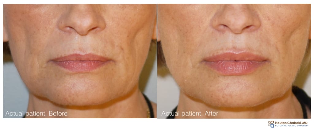 Lip injection with filler - before:after Juvederm