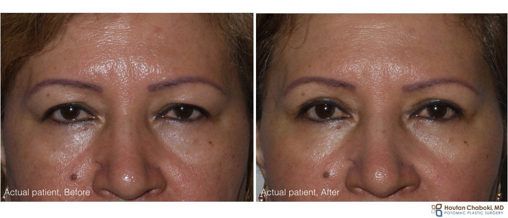 Upper eyelid surgery - before:after.001