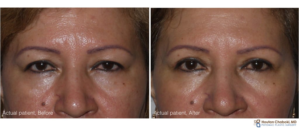 Upper eyelid surgery - before:after