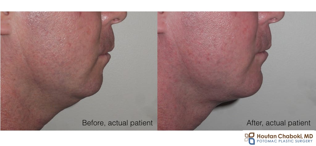 Before and after chin implant silicone neck liposuction Double chin submental fullness anatomy neck fat skin muscle bone