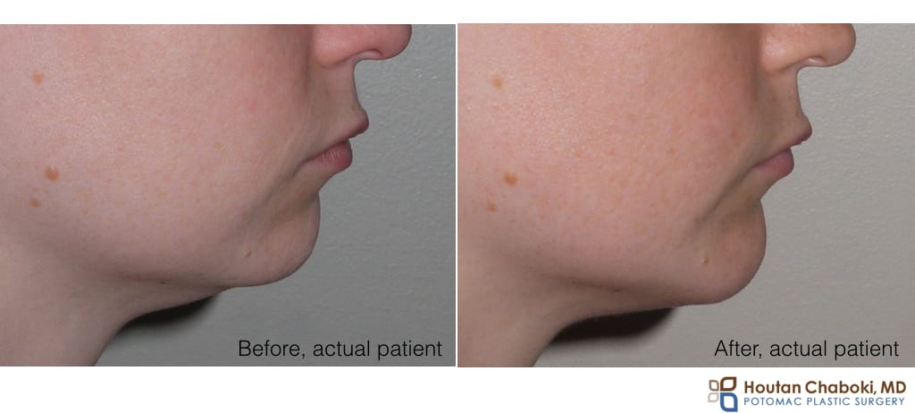 Before and after chin implant silicone Double chin submental fullness anatomy neck fat skin muscle bone