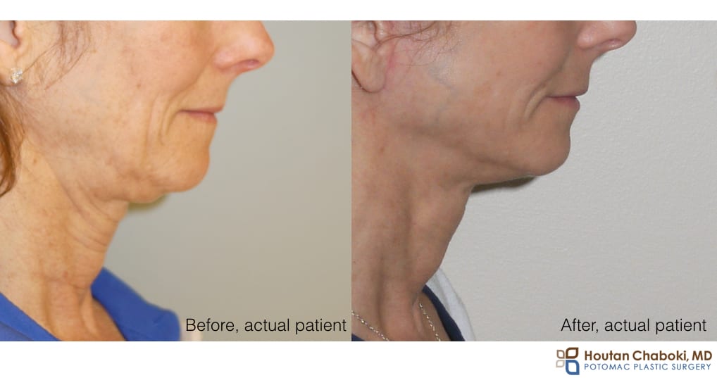 Before and after face lift neck lift Double chin submental fullness anatomy neck fat skin muscle bone