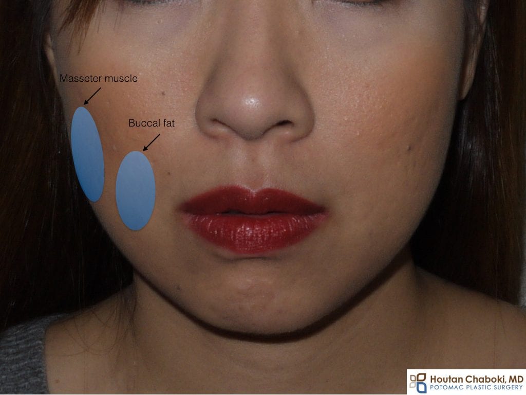 Buccal fat reduction Botox jaw masseter.001