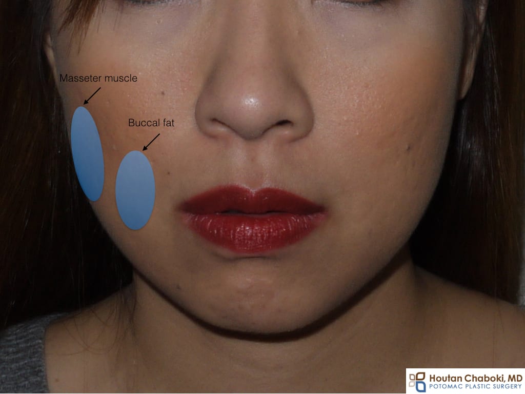 Buccal fat reduction Botox jaw master Washington DC