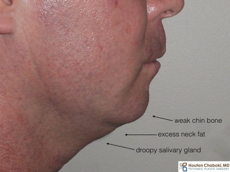 Double Chin Treatment Which Surgery Is Best? (Before and After Photos