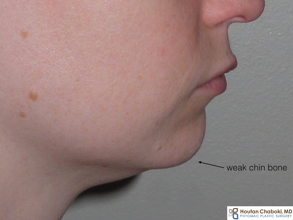 Double chin submental fullness anatomy neck fat skin muscle bone