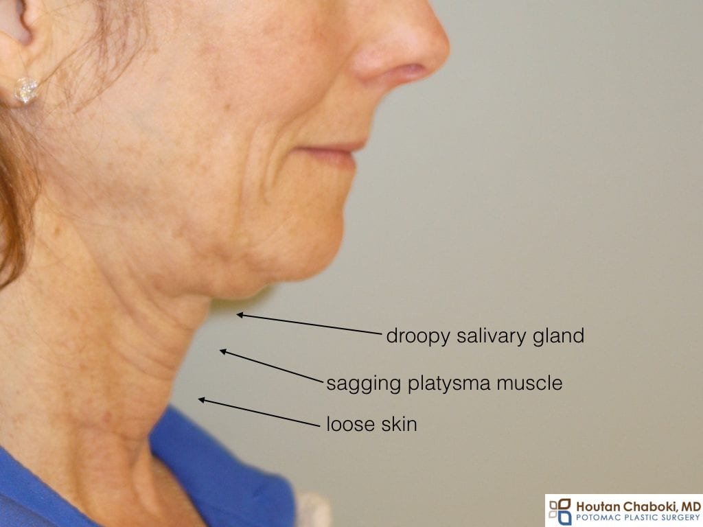 Double chin submental fullness anatomy neck fat skin muscle bone facelift