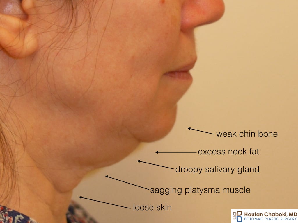 Double chin submental fullness anatomy neck fat skin muscle bone