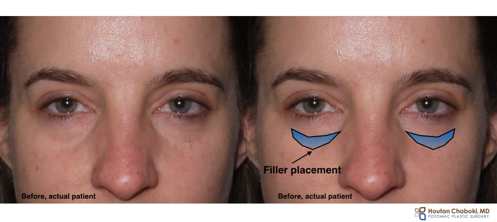 Want an Eye Lift Without Surgery? Here's How