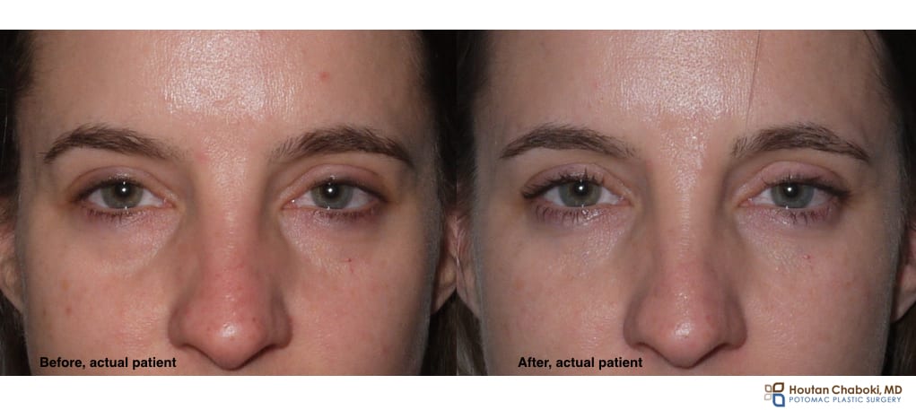 Lower eyelid facial filler bags tear trough Restylane