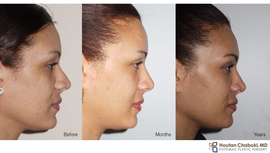 Before and After photo rhinoplasty swelling months years after surgery