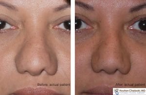 Before and after rhinoplasty nostril alar narrowing