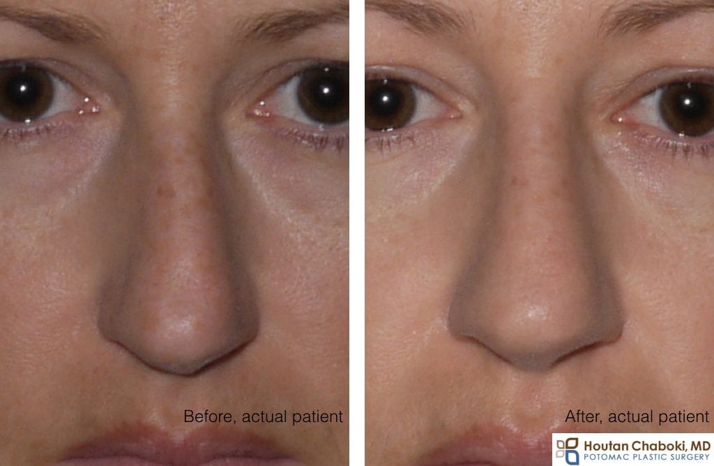 Before and after rhinoplasty septoplasty deviated nose
