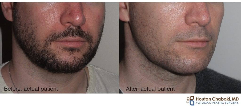 chin implant before after photos DC MD VA