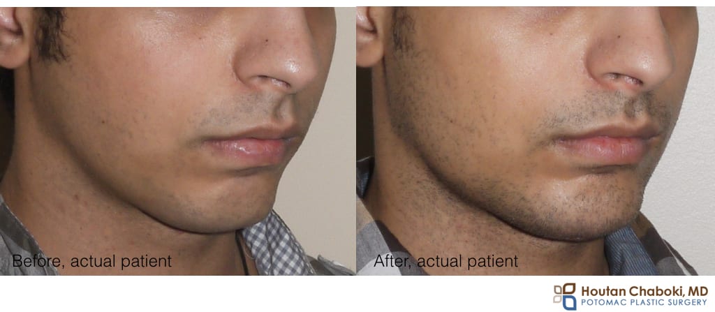 chin implant before after photos DC MD VA
