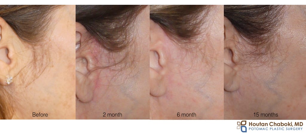 facelift neck lift scar incision healing time month year