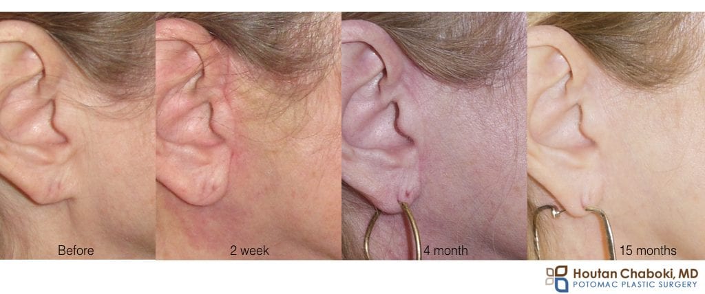 facelift neck lift scar incision healing time month year