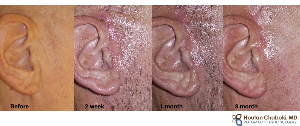 facelift neck lift scar incision healing time month year
