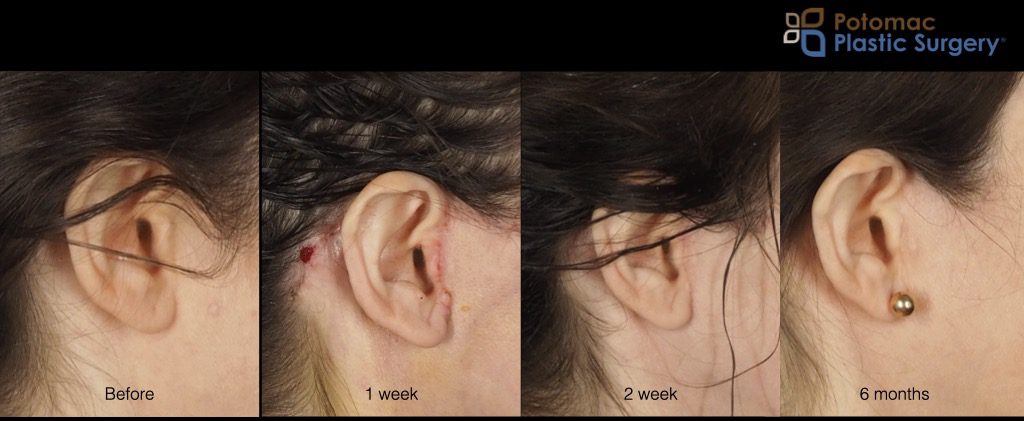 facelift neck lift scar incision healing time month year