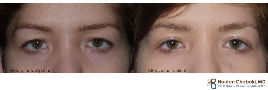 Before and after upper blepharoplasty eyelid surgery MD DC VA