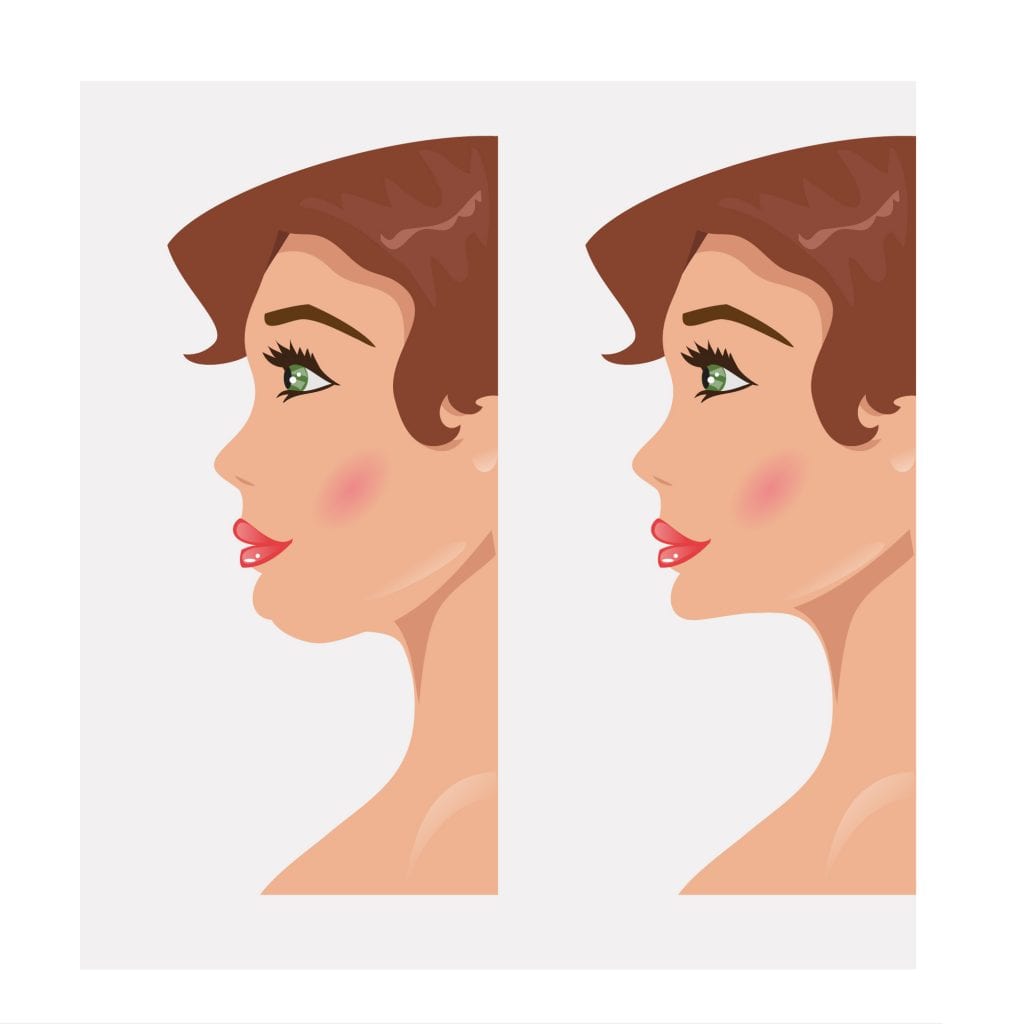 iIllustration woman before and after plastic surgery of neck face lift