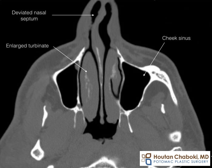 CT nose deviated septum enlarged turbinates sinus rhinoplasty