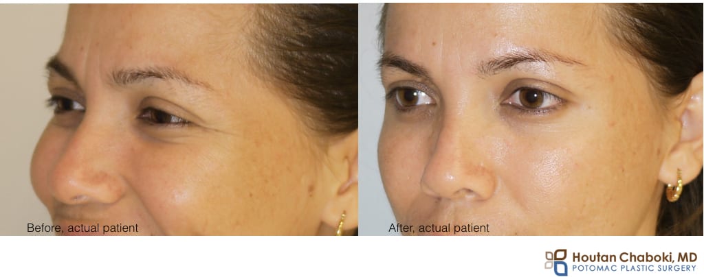 Blog post - before after Botox brow lift nonsurgical eyebrow