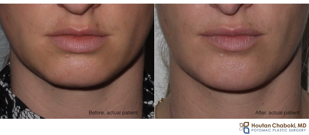 Blog post - before after phone chin augmentation silicon smiling smile scar