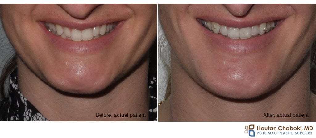 before after photo chin augmentation silicon smiling smile scar