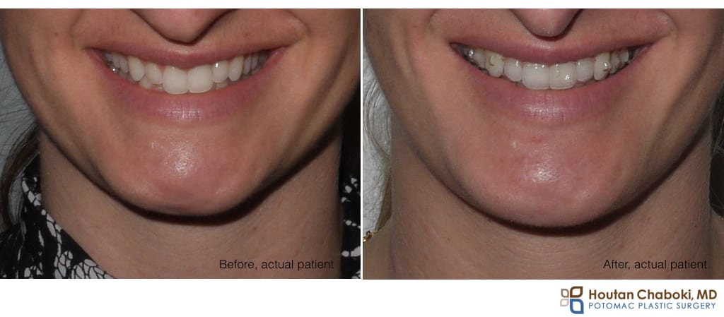 Blog post - before after phone chin augmentation silicon smiling smile scar