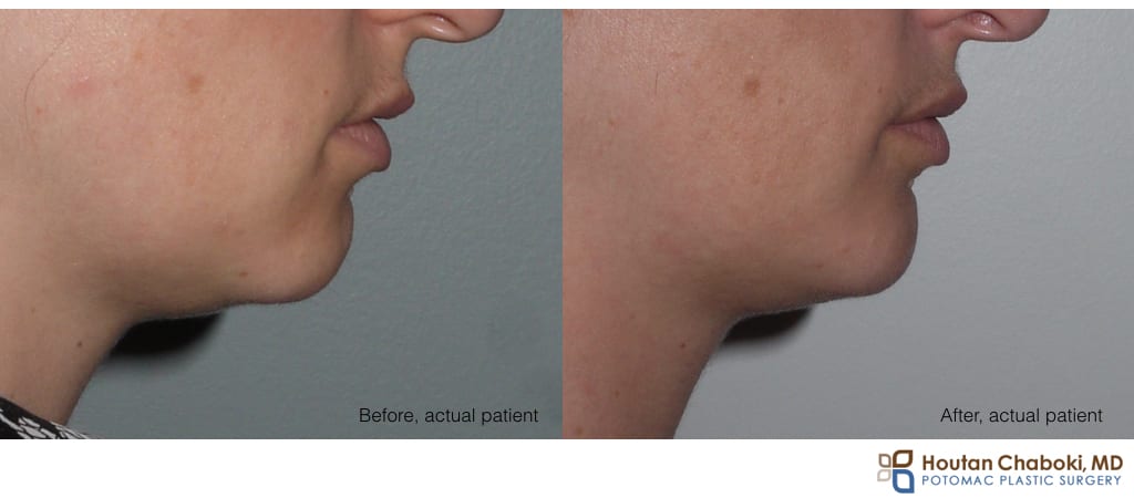 Blog post - before after phone chin augmentation silicon smiling smile scar