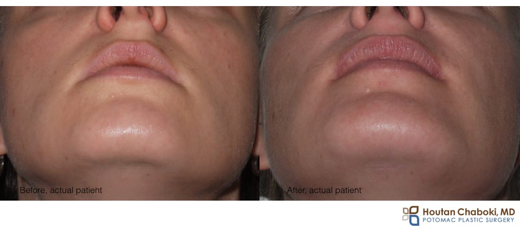 Blog post - before after phone chin augmentation silicon smiling smile scar