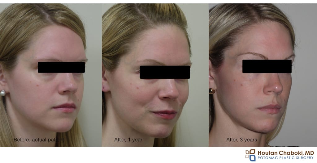 before after photo Restylane lower eyelid bags dark circle