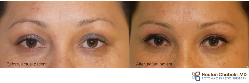 photo preventative Botox face wrinkle forehead skin anti aging