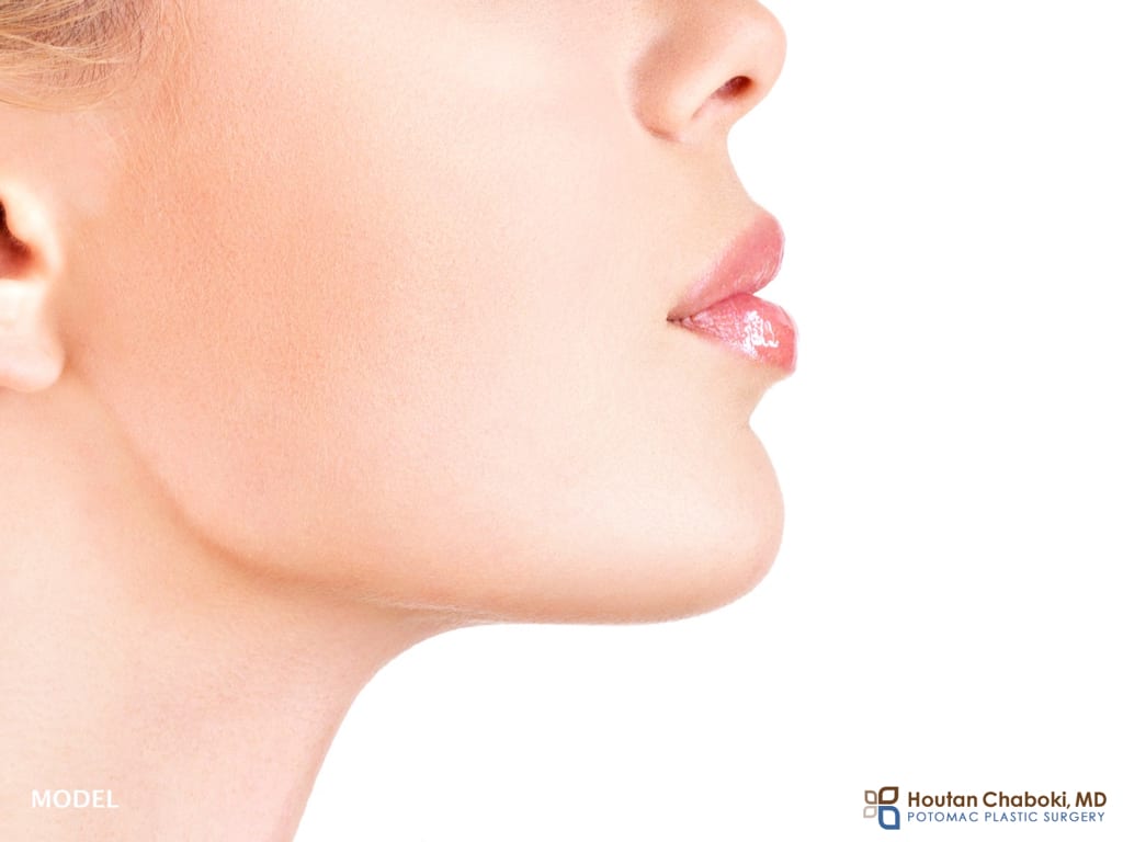 Blog Neck Kybella submental fullness fat double chin