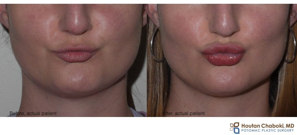 Blog post - before after lip enhancement augmentation injection facial filler kissing hyaluronic acid