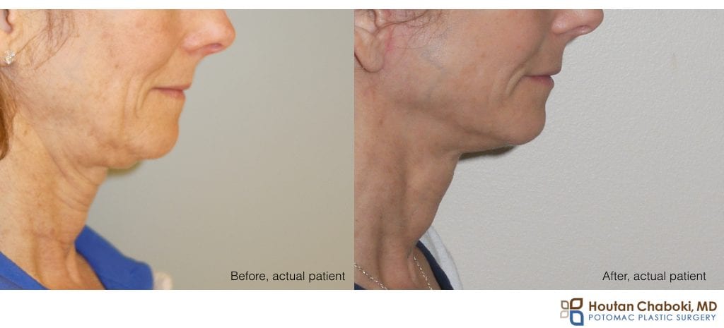 Blog post - before after photo facelift neck lift skin laxity plastic surgery.001