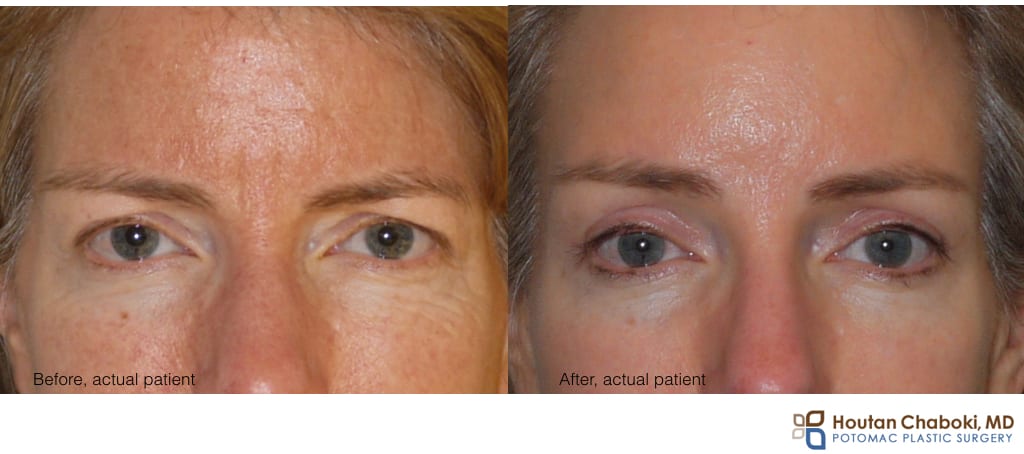 Blog post - before after photograph upper eyelid surgery forehead lift brow