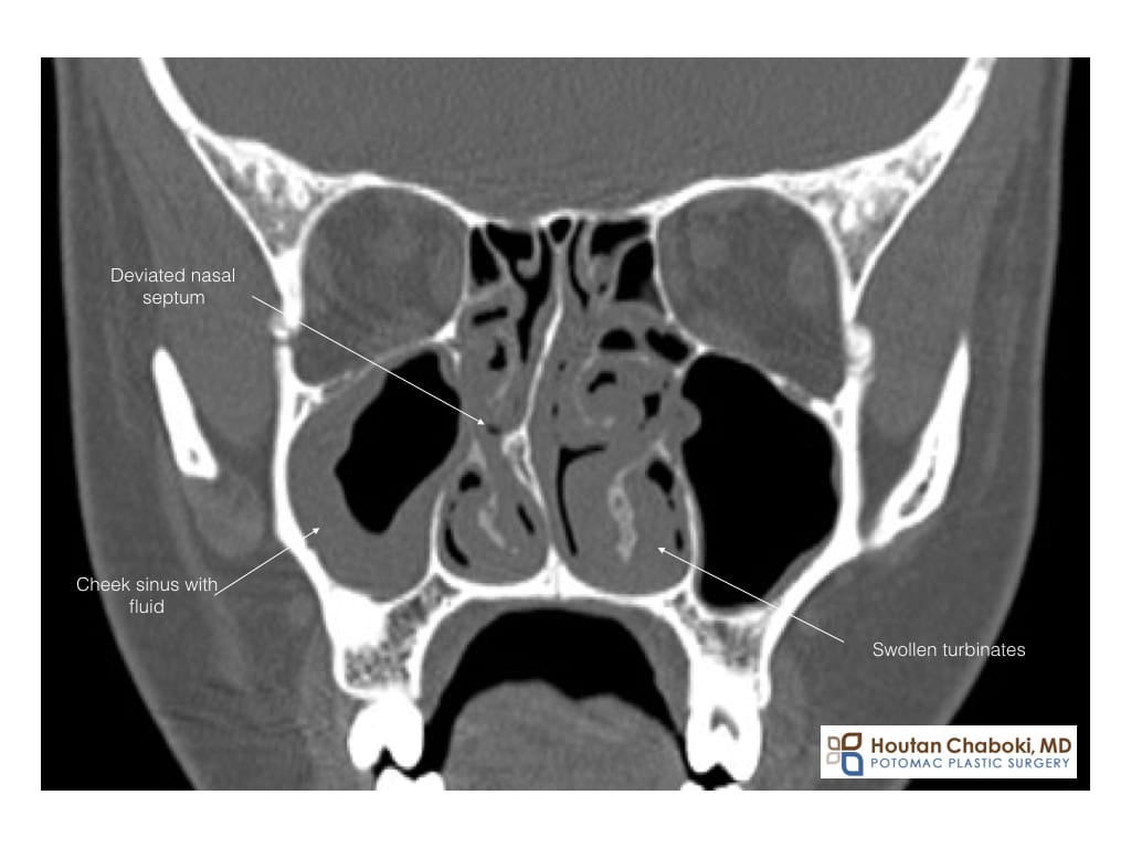 Blog post - CT sinus deviated septum turbinate septoplasty