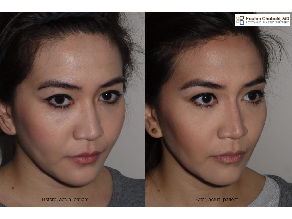 Blog post - before after Botox jaw reduction masseter FDA off label drug