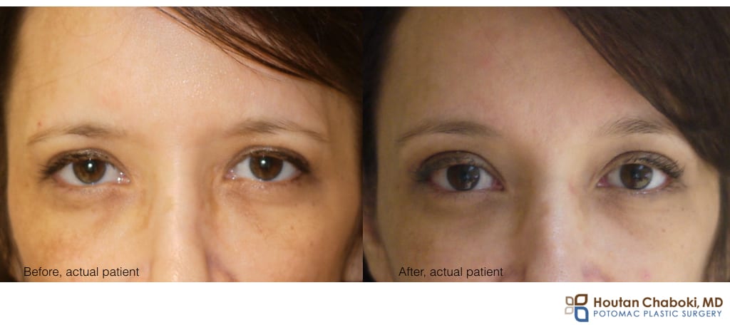 Blog post - before after brow lift forehead plastic surgery