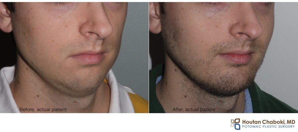 cheekbone implants men before and after