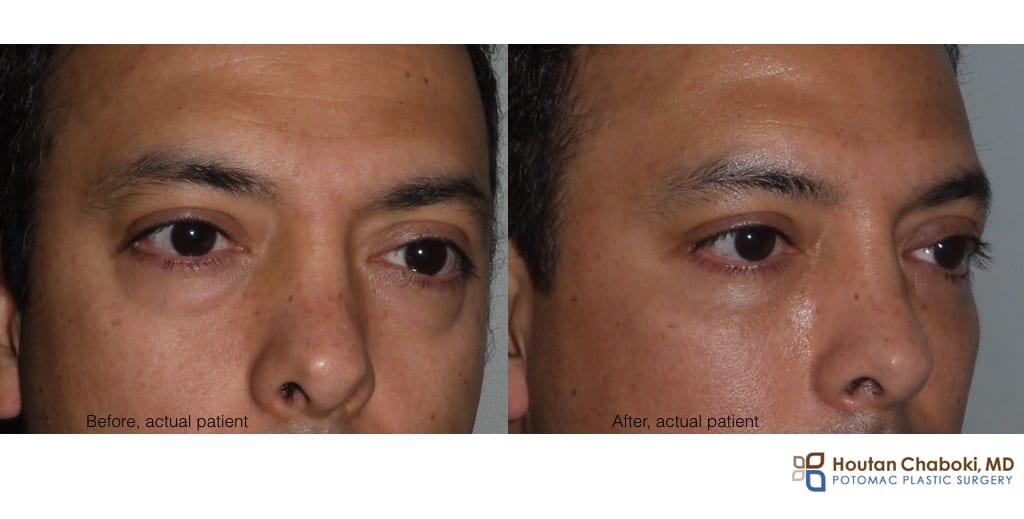 Blog post - before after photo fat transfer injection lip smile line lower eyelid cheek