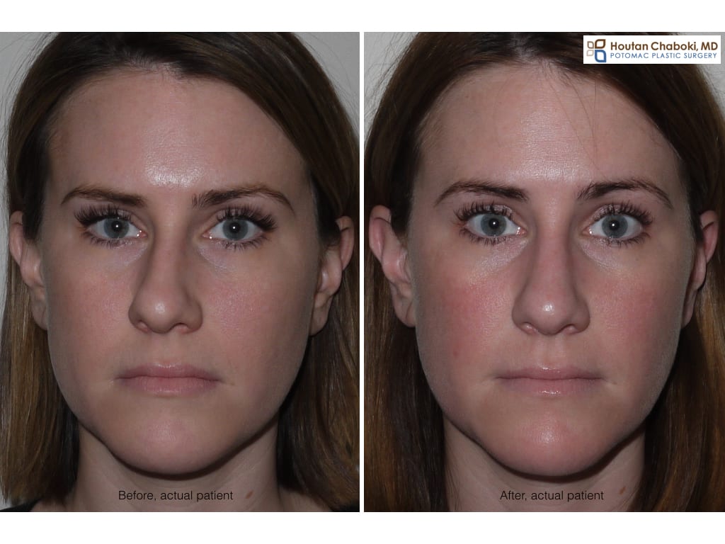 Blog post - before after septoplasty deviated septum closed rhinoplasty