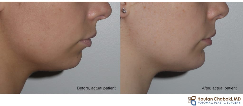 Blog post - before after chin augmentation plastic surgery implant silicone size extra large