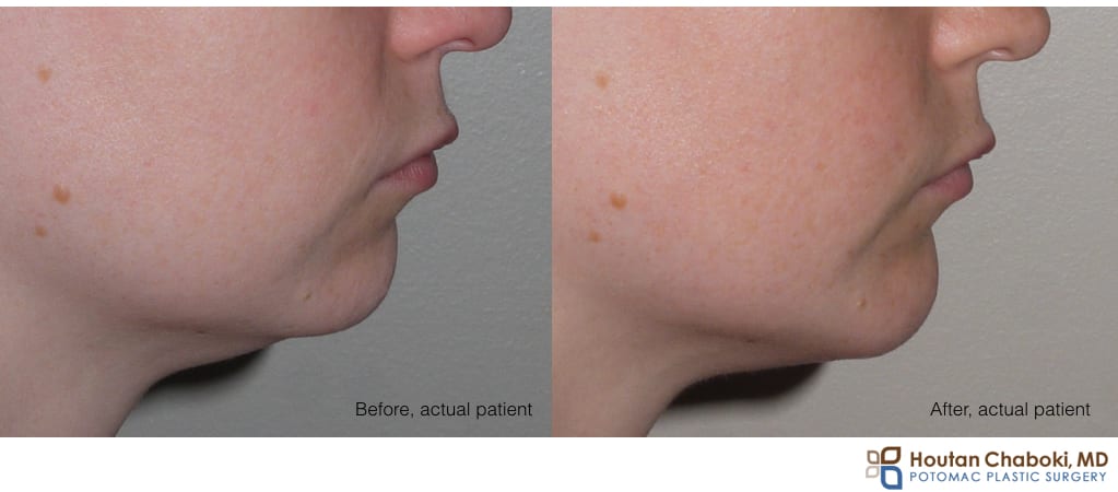 Blog post - before after chin augmentation plastic surgery implant silicone size large